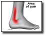 [ankle_peroneal_tendinitis_symptoms01.jpg]