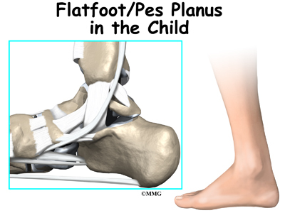 What kind of flat feet do I have and how can I make them flexible