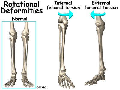 A) Femoral anteversion is the angle of rotation along the length of the