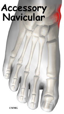 Accessory Navicular Problems | Orthogate