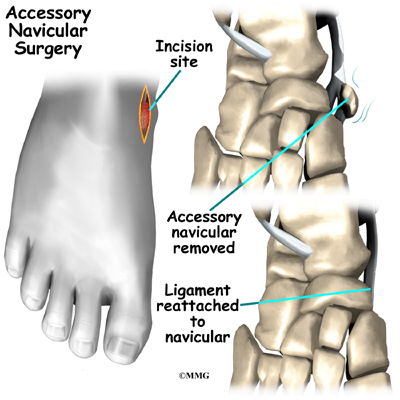 arch support for accessory navicular bone