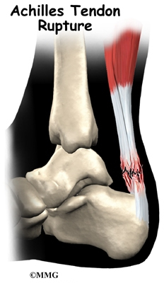 strained heel tendon