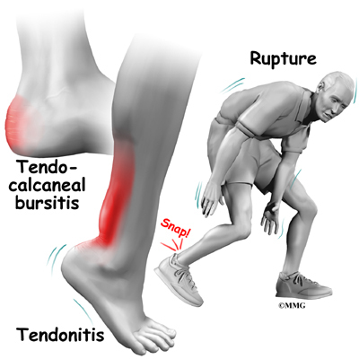pain in the achilles tendon area