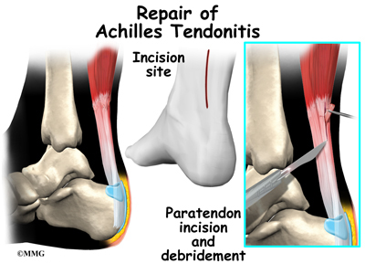 Achilles Tendinitis Treatment Prospect | Achilles Tendonopathy