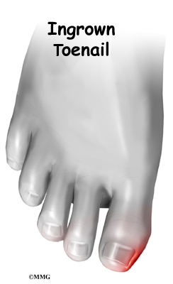 Ingrown Toe Nails – Nevada Foot Institute