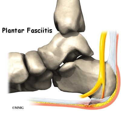 heel pain from plantar fasciitis