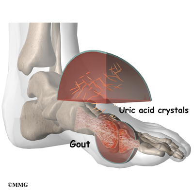 How To Treat Gout Of The Big Toe - The Orthopaedic Foot & Ankle Center