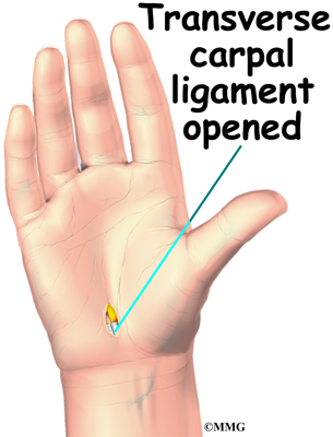 Open Carpal Tunnel Surgery