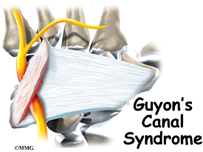 Ulnar Nerve Compression in Guyon's Canal