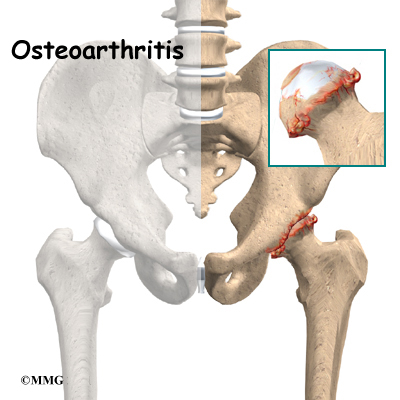 Osteoarthritis of the Hip | Orthogate