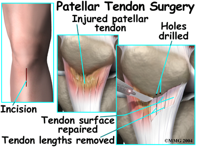 patella knee surgery