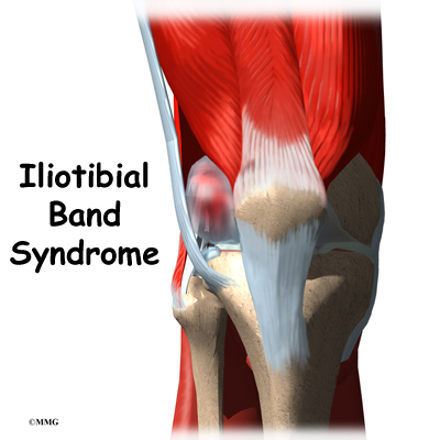 Iliotibial Band - A common source of hip and/or knee pain