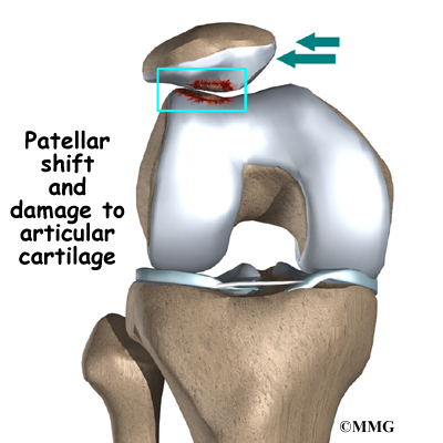 knee compartments chondromalacia