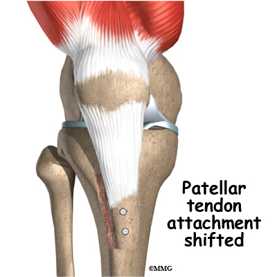 patella chondromalacia knee surgery realignment treatment patellar eorthopod bony tendon severe nonsurgical treatments conditions