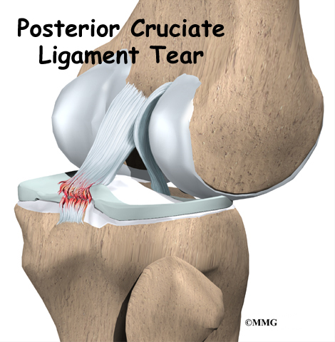 Posterior Cruciate Ligaments Injuries (PCL)