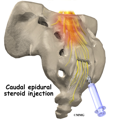 steroid injection for bones