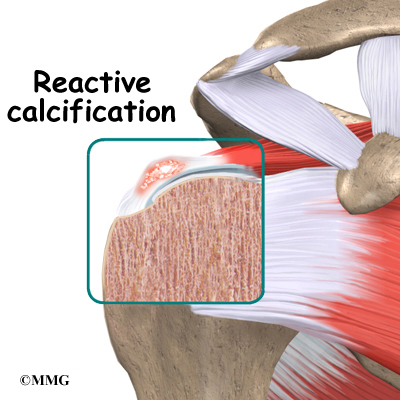 Calcific Tendonitis Of The Shoulder