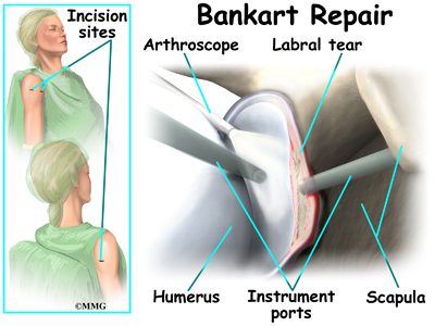  This leads to laxity of posterior band of the inferior glenohumeral ligament with posterior displacement of the humeral head As is the case with a Bankart lesion, the trauma may be severe enough to involve the bony glenoid, resulting in an accompanying small flake 