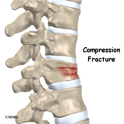 A Patient's Guide to Lumbar Compression Fracture