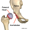 Artificial Joint Replacement of the Hip, Anterior Approach