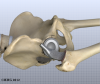 Artificial Joint Replacement of the Hip, Anterior Approach