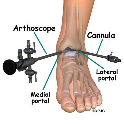 Ankle Arthroscopy Eorthopod Com