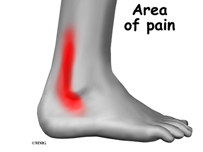 Peroneal Tendon Problems