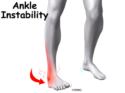 High Ankle Sprain - Ankle Syndesmosis | eOrthopod.com