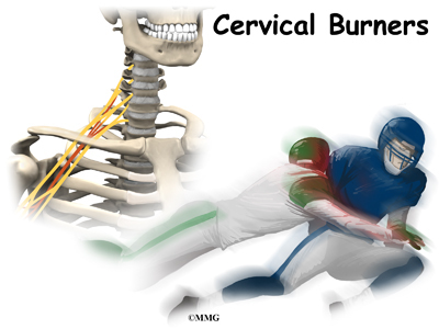 Cervical Burners and Stingers