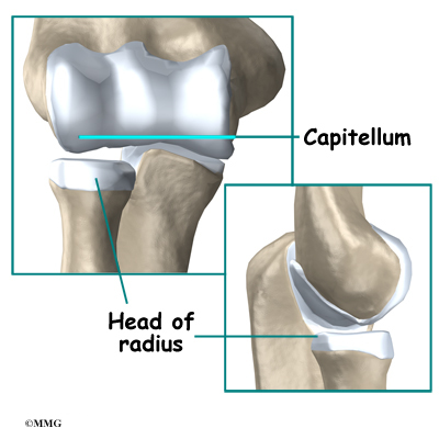 Adolescent Osteochondritis Dissecans Of The Elbow Eorthopod Com