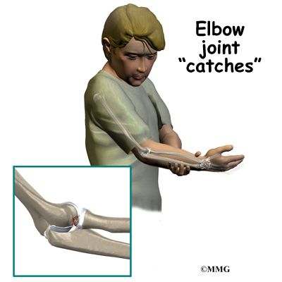 Your elbow doesn't have to be perfectly straight, this is a fix
