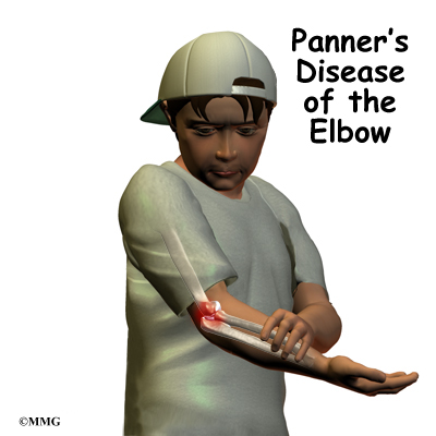Panner's Disease