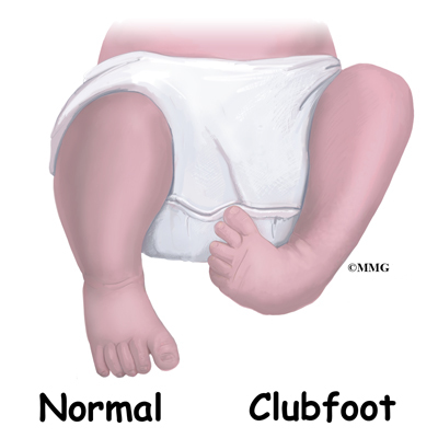 Clubfoot 