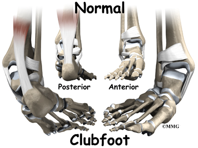 Total 45+ imagen club foot bones