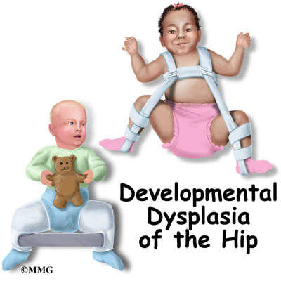 hip dysplasia baby