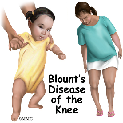 Blountâs Disease in Children and Adolescents