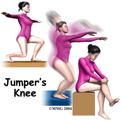 Jumper's Knee