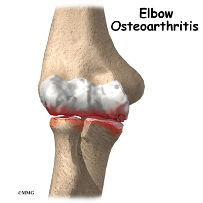 Elbow Arthritis
