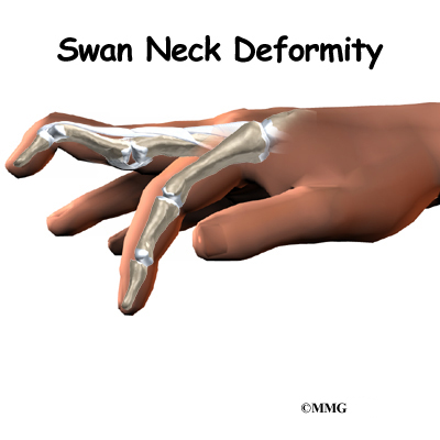 Swan Neck Deformity