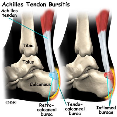 Achilles Tendon Problems