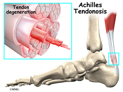 Achilles Tendon Problems