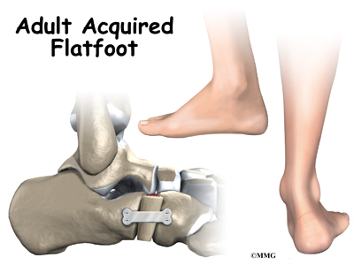 Adult-Acquired Flatfoot Deformity