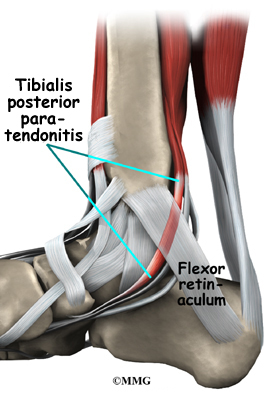 Posterior Tibial Tendon Problems