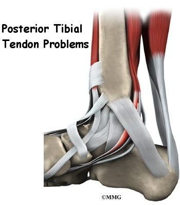Posterior Tibial Tendon Problems