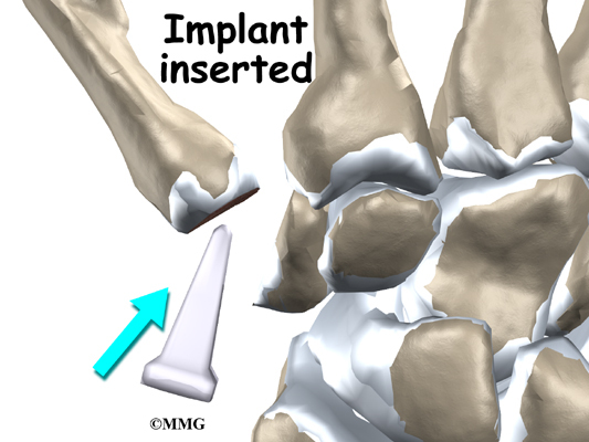 Artificial Joint Replacement of the Thumb | eOrthopod.com