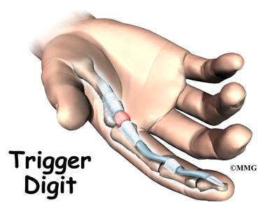 Trigger Finger and Trigger Thumb