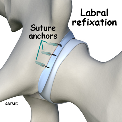 Labral Tears of the Hip