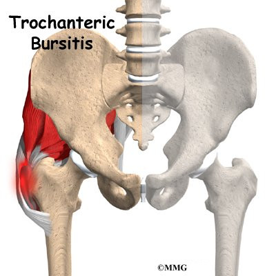 Trochanteric Bursitis of the Hip