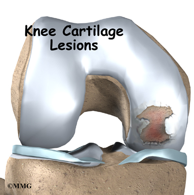 Knee Articular Cartilage Problems