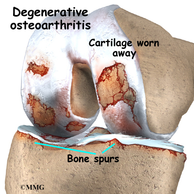 Glucosamine and Chondroitin Sulfate for Osteoarthritis of the Knee